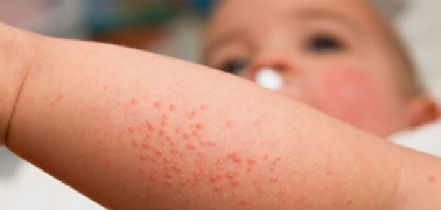 Skin Rash 101: How to Identify Them