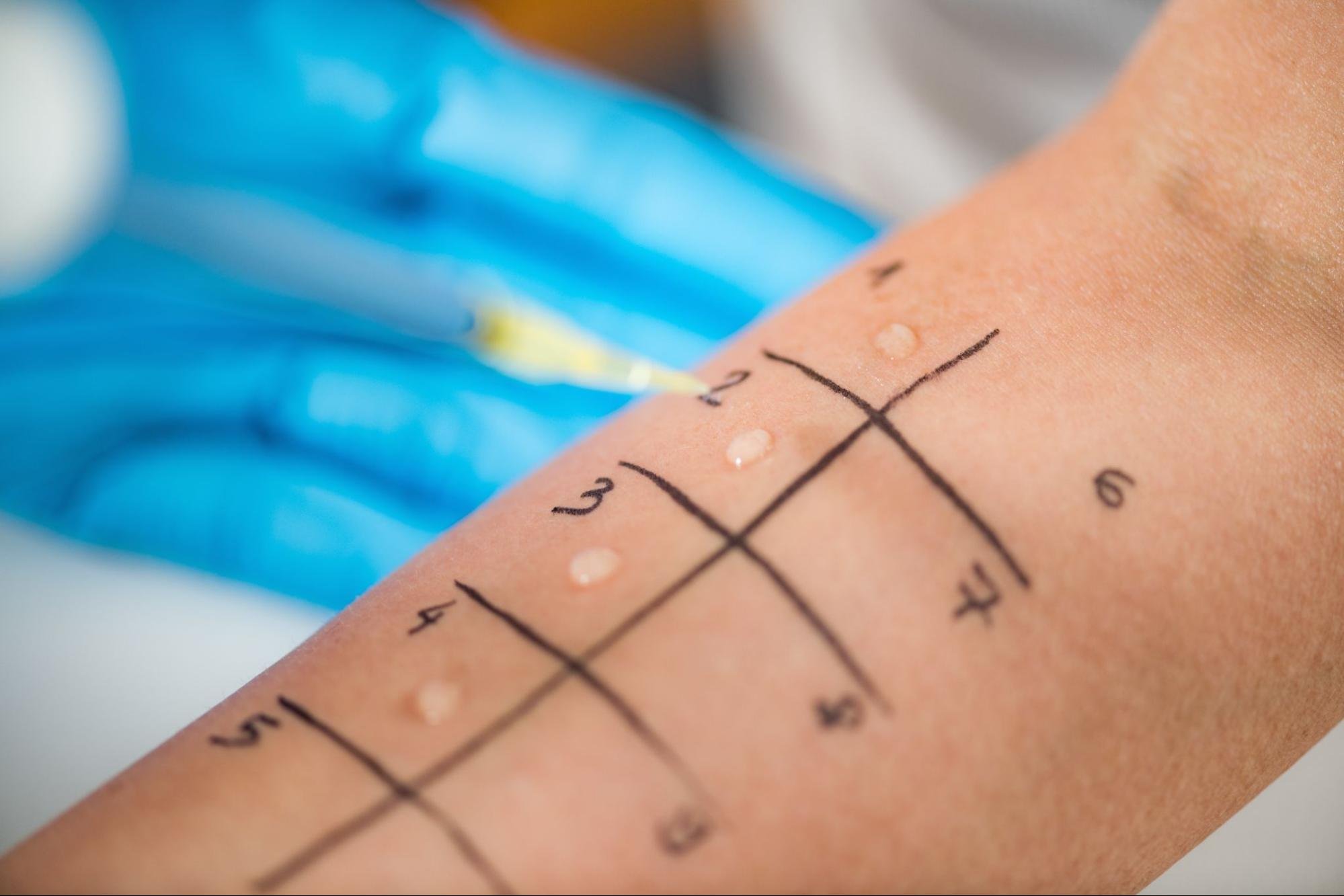 A skin prick allergy panel test on a person’s arm